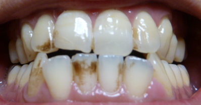 プレミアムブラントゥース歯の写真初日前歯